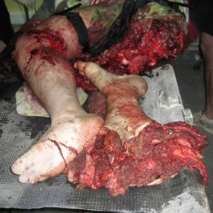 11. Iraqi teenage girl’s leg was severed in a firefight with terrorists in Tikrit 2008.